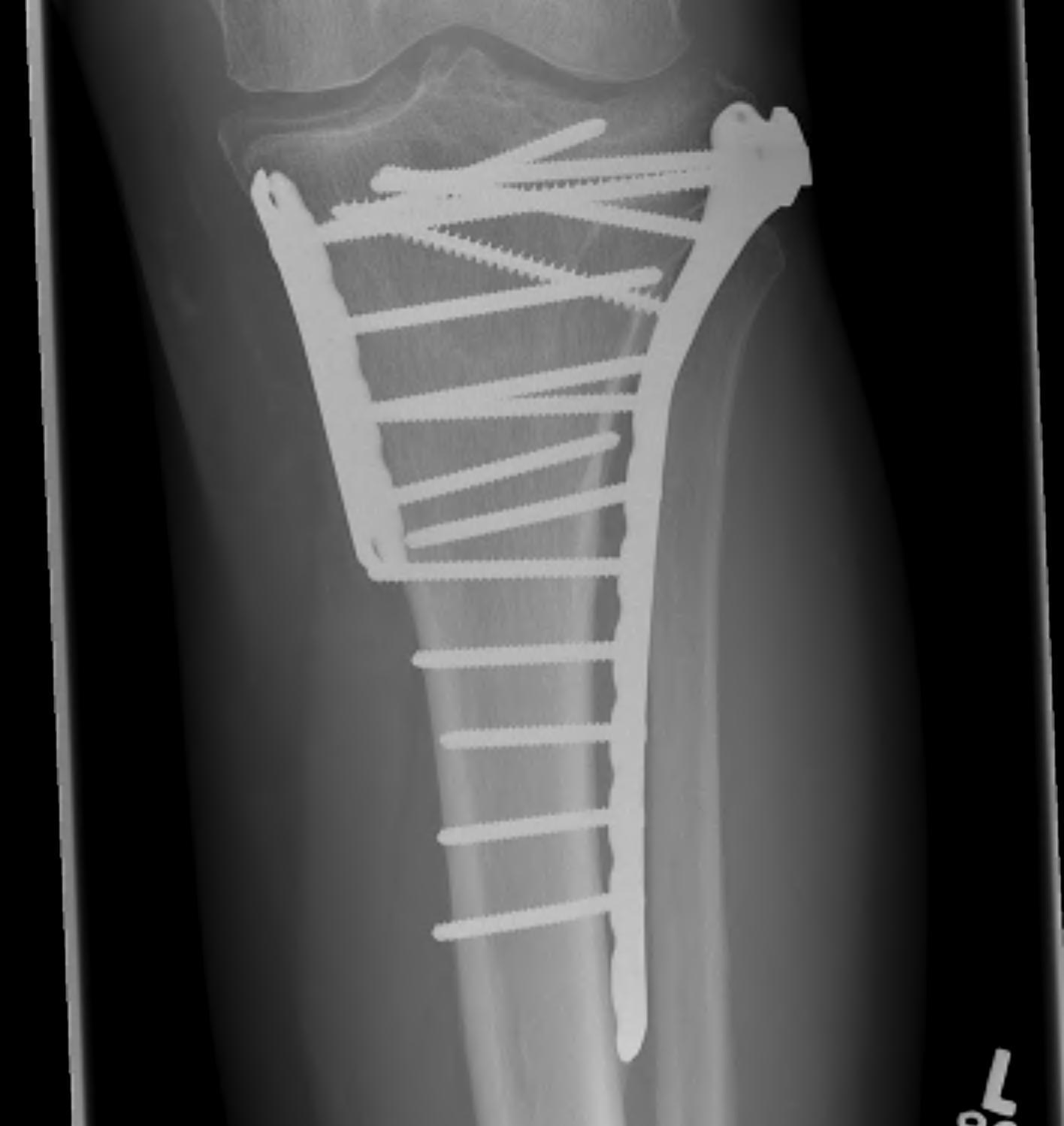 Tibial Plateau Bicondylar ORIF AP